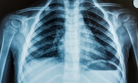 KI analysiert erstmals Röntgenbild ohne Radiologen